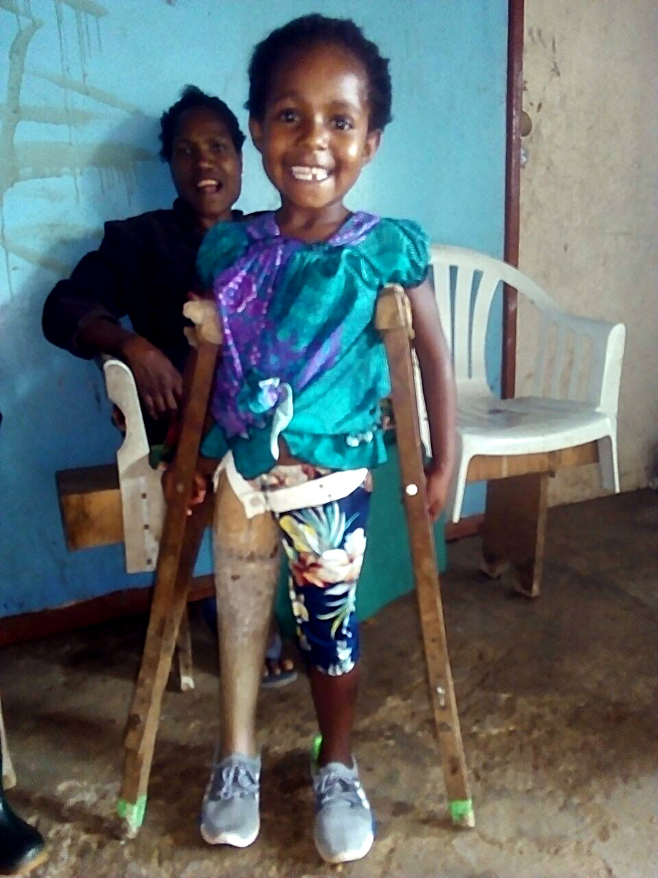 Violet stands in front of her mum using her crutches and wearing her first prosthesis during her first fitting.